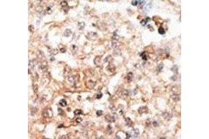 IHC analysis of FFPE human hepatocarcinoma tissue stained with the Osteocalcin antibody (Osteocalcin antibody  (AA 2-32))