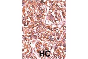Formalin-fixed and paraffin-embedded human cancer tissue reacted with the primary antibody, which was peroxidase-conjugated to the secondary antibody, followed by AEC staining. (Retinoblastoma 1 antibody  (pSer612))