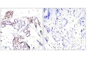 Immunohistochemical analysis of paraffin-embedded human breast carcinoma tissue using Elk1(Phospho-Ser389) Antibody(left) or the same antibody preincubated with blocking peptide(right). (ELK1 antibody  (pSer389))
