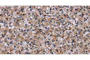 Immunohistochemistry of paraffin-embedded Human prostate cancer using IPO4 Polyclonal Antibody at dilution of 1:50 (Importin 4 antibody)