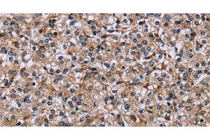 Immunohistochemistry of paraffin-embedded Human prostate cancer using IPO4 Polyclonal Antibody at dilution of 1:50 (Importin 4 antibody)