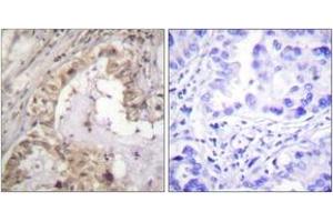 Immunohistochemistry analysis of paraffin-embedded human lung carcinoma tissue, using BCL-XL (Ab-47) Antibody. (BCL2L1 antibody  (AA 13-62))