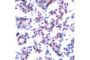 Immunohistochemistry of paraffin-embedded human breast carcinoma using Phospho-JUNB-S259 antibody (ABIN2988088). (JunB antibody  (pSer259))