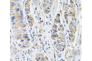 Immunohistochemistry of paraffin-embedded Human liver cancer using VAPB Polyclonal Antibody at dilution of 1:200 (40x lens).