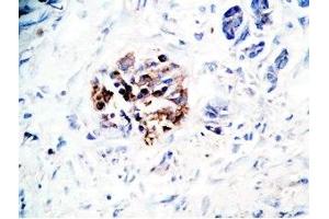 Human pancreas cancer tissue was stained by Rabbit Anti-GLP-1(7-36) -NH2 Antibody (GLP-1 antibody  (amidated))