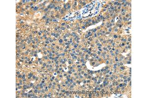 Immunohistochemistry of Human ovarian cancer using DHCR24 Polyclonal Antibody at dilution of 1:40 (Seladin 1 antibody)