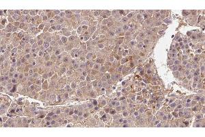 ABIN6273354 at 1/100 staining Human liver cancer tissue by IHC-P. (DIRAS3 antibody  (C-Term))