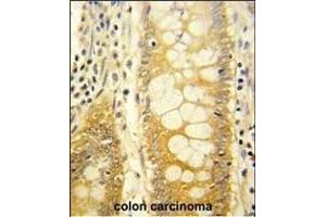 Formalin-fixed and paraffin-embedded human colon carcinoma reacted with LGALS2 Antibody (Center), which was peroxidase-conjugated to the secondary antibody, followed by DAB staining. (Galectin 2 antibody  (AA 85-111))