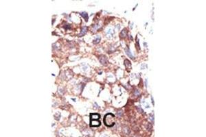Formalin-fixed and paraffin-embedded human cancer tissue reacted with the primary antibody, which was peroxidase-conjugated to the secondary antibody, followed by DAB staining. (Ubiquilin 1 antibody  (N-Term))