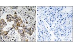 Immunohistochemistry analysis of paraffin-embedded human breast carcinoma tissue, using KCNK15 Antibody. (KCNK15 antibody  (AA 273-322))