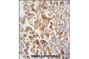 TEX13B antibody (C-term) (ABIN654849 and ABIN2844514) immunohistochemistry analysis in formalin fixed and paraffin embedded human testis carcinoma followed by peroxidase conjugation of the secondary antibody and DAB staining. (TEX13B antibody  (C-Term))