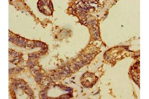 Immunohistochemistry of paraffin-embedded human endometrial cancer using ABIN7149526 at dilution of 1:100 (DCAF8 antibody  (AA 1-135))