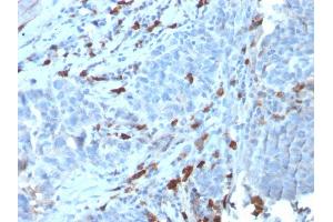 Formalin-fixed, paraffin-embedded human Tumor stained with IgM Recombinant Rabbit Monoclonal Antibody (IGHM/3135R). (Recombinant IGHM antibody)