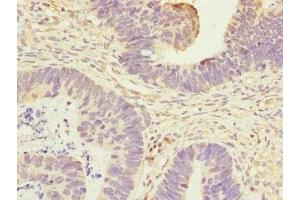 Immunohistochemistry of paraffin-embedded human ovarian cancer using ABIN7144326 at dilution of 1:100 (ANTXR2 antibody  (AA 340-489))