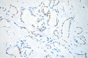 Immunohistochemistry was performed on paraffin-embedded human papillary thyroid carcinoma using NK2 homeobox 1 antibody (ABIN7799607), 1:200). (Recombinant NKX2-1 antibody)