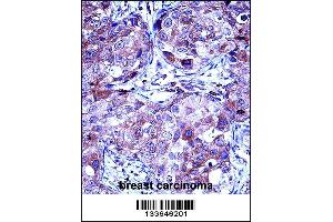 MMP13 Antibody immunohistochemistry analysis in formalin fixed and paraffin embedded human breast carcinoma followed by peroxidase conjugation of the secondary antibody and DAB staining. (MMP13 antibody  (AA 253-282))