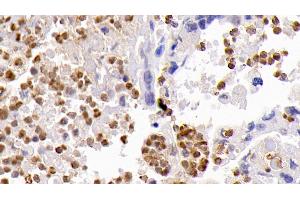 Detection of CASP3 in Human Lung cancer Tissue using Monoclonal Antibody to Caspase 3 (CASP3) (Caspase 3 antibody  (AA 29-175))