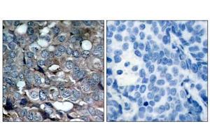 Immunohistochemical analysis of paraffin-embedded human breast carcinoma tissue using ASK1 (phospho-Ser83) antibody (E011178). (ASK1 antibody  (pSer83))