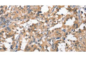 Immunohistochemistry of paraffin-embedded Human thyroid cancer tissue using HGF Polyclonal Antibody at dilution 1:65 (HGF antibody)
