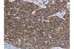 The image on the left is immunohistochemistry of paraffin-embedded Human cervical cancer tissue using ABIN7192846(TNPO1 Antibody) at dilution 1/25, on the right is treated with synthetic peptide. (Transportin 1 antibody)