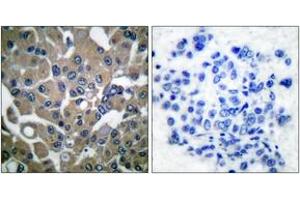 Immunohistochemistry analysis of paraffin-embedded human breast carcinoma, using PLCG1 (Phospho-Tyr783) Antibody. (Phospholipase C gamma 1 antibody  (pTyr783))