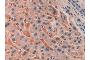 DAB staining on IHC-P; Samples: Human Liver cancer Tissue (SIGLEC12 antibody  (AA 22-218))