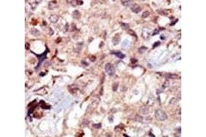 IHC analysis of FFPE human breast carcinoma tissue stained with the MLCK antibody (MYLK antibody  (AA 908-938))