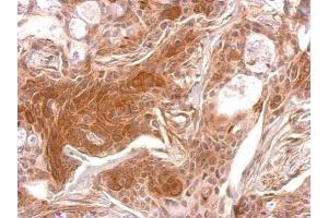 IHC-P Image TPK1 antibody detects TPK1 protein at cytosol on Cal27 xenograft by immunohistochemical analysis. (TPK1 antibody)