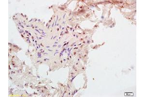 Formalin-fixed and paraffin embedded human rectal carcinoma tissue labeled with Anti-CPT1B Polyclonal Antibody, Unconjugated (ABIN708851) at 1:200, followed by conjugation to the secondary antibody and DAB staining (CPT1B antibody  (AA 501-600))