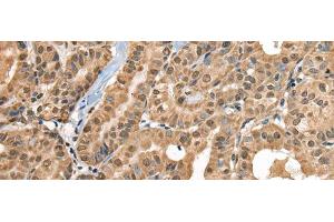 Immunohistochemistry of paraffin-embedded Human thyroid cancer tissue using RTCB Polyclonal Antibody at dilution of 1:30(x200) (C22orf28 antibody)