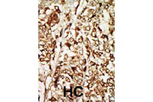 Formalin-fixed and paraffin-embedded human hepatocellular carcinoma tissue reacted with MOS polyclonal antibody  , which was peroxidase-conjugated to the secondary antibody, followed by AEC staining. (MOS antibody  (N-Term))
