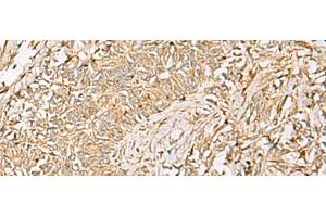 Immunohistochemistry of paraffin-embedded Human ovarian cancer tissue using QDPR Polyclonal Antibody at dilution of 1:70(x200) (QDPR antibody)