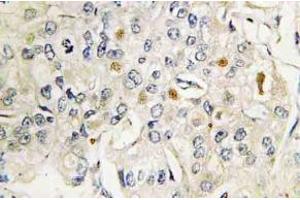 Immunohistochemistry (IHC) analyzes of VDR antibody in paraffin-embedded human breast carcinoma tissue. (Vitamin D Receptor antibody)