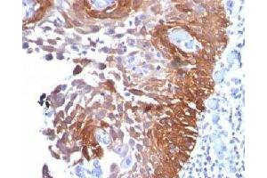 IHC testing of cervical carcinoma stained with Cytokeratin 17 antibody. (KRT17 antibody)