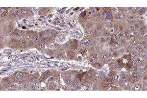 ABIN6276476 at 1/100 staining Human liver cancer tissue by IHC-P. (RHOC antibody  (C-Term))