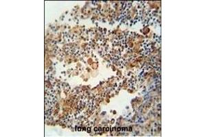 OR9Q1 antibody (C-term) (ABIN654850 and ABIN2844515) immunohistochemistry analysis in formalin fixed and paraffin embedded human lung carcinoma followed by peroxidase conjugation of the secondary antibody and DAB staining. (OR9Q1 antibody  (C-Term))