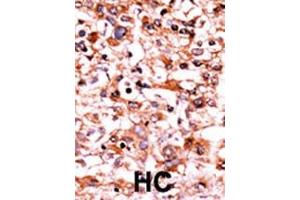 Formalin-fixed and paraffin-embedded human cancer tissue reacted with the primary antibody, which was peroxidase-conjugated to the secondary antibody, followed by AEC staining. (CDK1 antibody  (pSer39))