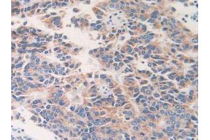 IHC-P analysis of Human Prostate Cancer Tissue, with DAB staining. (ETFB antibody  (AA 2-255))