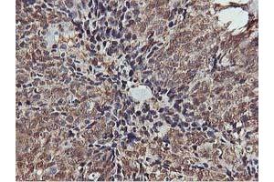 Immunohistochemical staining of paraffin-embedded Adenocarcinoma of Human breast tissue using anti-AKT1 mouse monoclonal antibody. (AKT1 antibody)