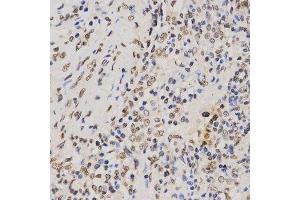 Immunohistochemistry of paraffin-embedded human lung cancer using TriMethyl-Histone H3-K79 antibody. (Histone 3 antibody  (H3K79me3))