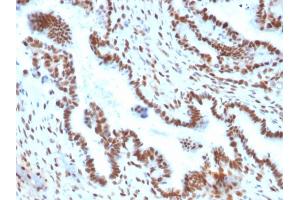 Formalin-fixed, paraffin-embedded human Endometrial Carcinoma stained with TLE1 Mouse Monoclonal Antibody (TLE1/2051). (TLE1 antibody  (AA 175-338))