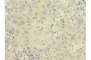 Immunohistochemistry of paraffin-embedded human liver cancer using ABIN7175581 at dilution of 1:100 (CACNA2D2 antibody  (AA 20-200))