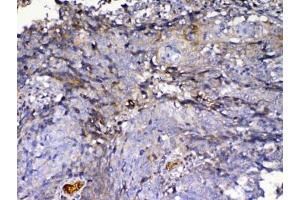 IHC testing of FFPE human lung cancer tissue with IGFBP2 antibody at 1ug/ml. (IGFBP2 antibody)