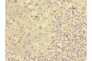 Immunohistochemistry of paraffin-embedded human liver cancer using ABIN7149008 at dilution of 1:100 (CSRP2 antibody  (AA 1-193))