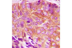 Immunohistochemical analysis of BIK (pT33) staining in human breast cancer formalin fixed paraffin embedded tissue section. (BIK antibody  (N-Term, pSer33))