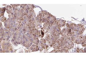 ABIN6273288 at 1/100 staining Human pancreas cancer tissue by IHC-P. (PCCA antibody  (C-Term))