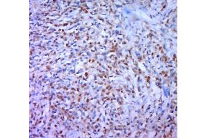 Paraformaldehyde-fixed, paraffin embedded human gastric carcinoma; Antigen retrieval by boiling in sodium citrate buffer (pH6. (DAXX antibody  (pSer668))
