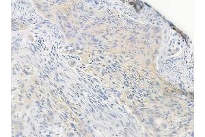 ABIN6259417 and ABIN6276191 at 1/100 staining human tongue carcinoma by IHC-P.