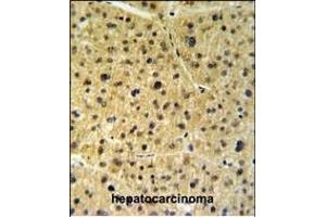 FKBP9 Antibody (N-term) (ABIN391580 and ABIN2841514) IHC analysis in formalin fixed and paraffin embedded human hepatocarcinoma followed by peroxidase conjugation of the secondary antibody and DAB staining. (FKBP9 antibody  (N-Term))