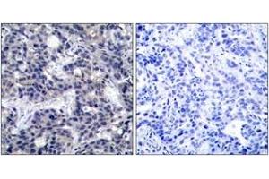 Immunohistochemistry analysis of paraffin-embedded human breast carcinoma tissue, using PKR (Ab-446) Antibody. (EIF2AK2 antibody  (AA 413-462))